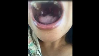My Uvula 1