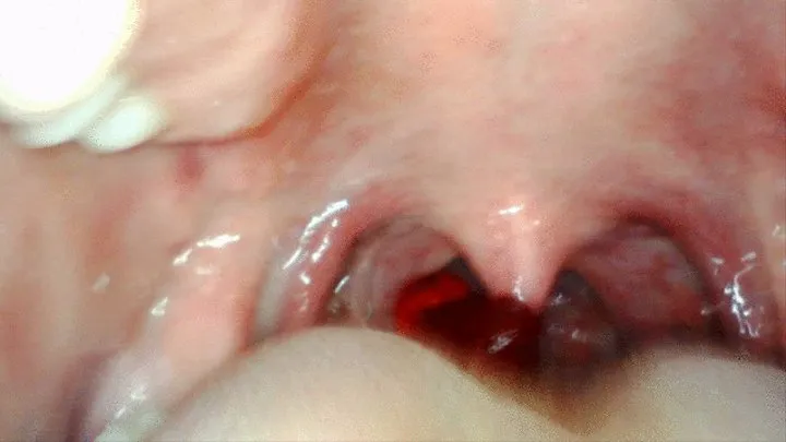 Endoscope gummy vore