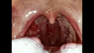 Close up of my throat coughing