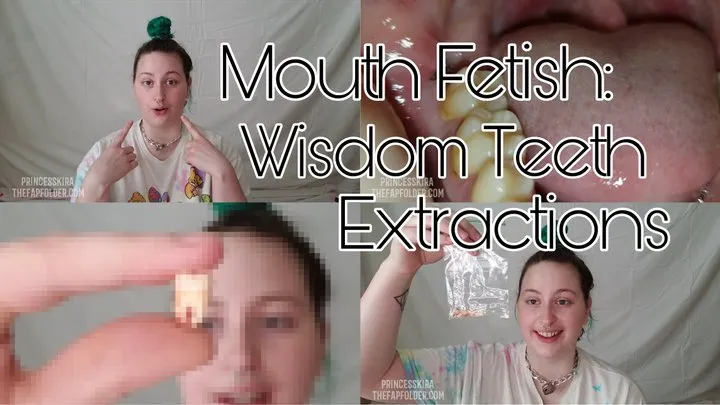 Video Diary: Wisdom Teeth Extraction