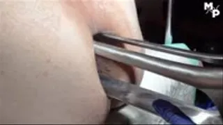 Extremely anal stretching with a giant speculum