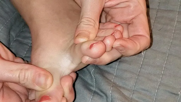 Toe Spreading