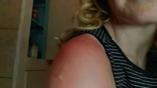 Peeling My Sunburn Off