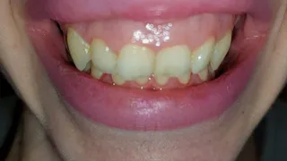 My teeth are chattering - pt9