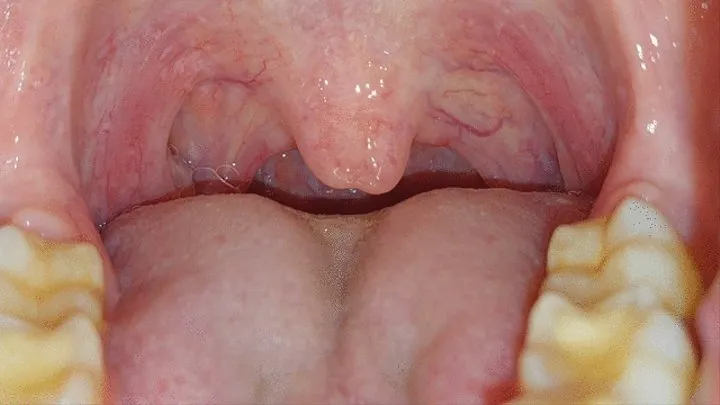 Uvula tour