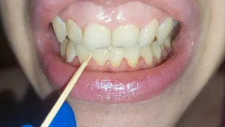 Scratching my teeth with a toothpick