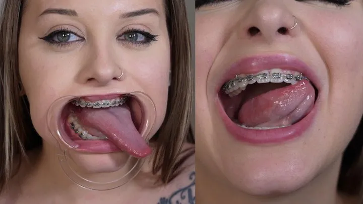 Braces Mouth Tour 3