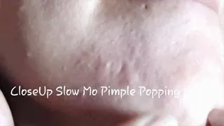 PImple Popping Upclose Slowmo Face and zit fetish