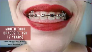Mouth Tour Braces Fetish (2 years)