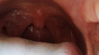 Yawning uvula closeup