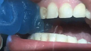 Teeth vs gummies