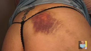 Booty Bruised and Confused