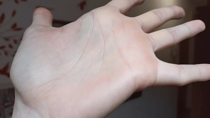 Alexa's stretched palm skin