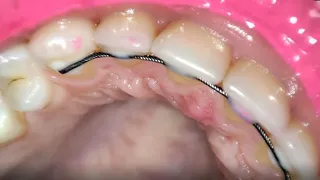 permanent retainers mouth tour