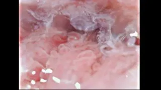 Cervical Canal