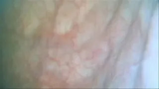 endoscope in my bladder