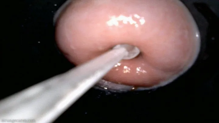 cervix sounding endoscopy quickie