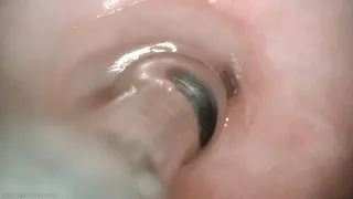 juicy cervix sounding