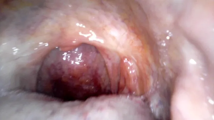 Holy uvula! Endoscope camera used