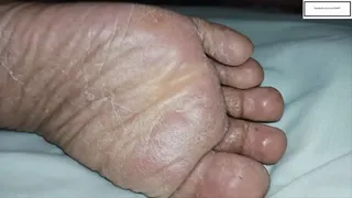 Delicious Athletes Foot inspection upclose