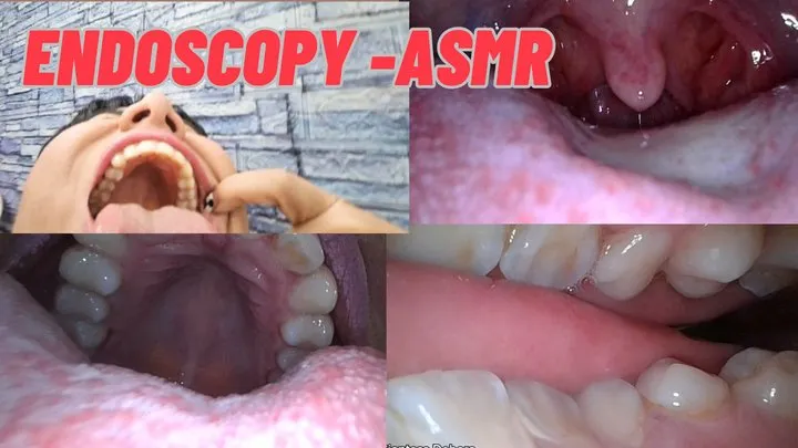 Vore endoscopy -ASMR