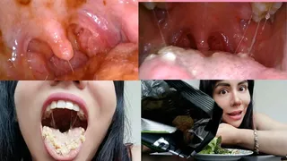 Eating a lot of food -Endoscopy