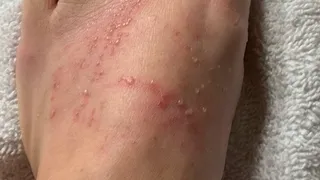 Foot Blisters 3