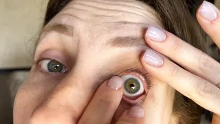 Deformity of the eyeball
