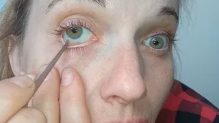 Emergency surgery on my eyes!