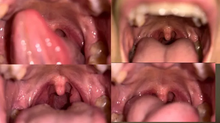 Nathalias Uvula Cam