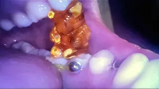 Gummy Bear Swallowing