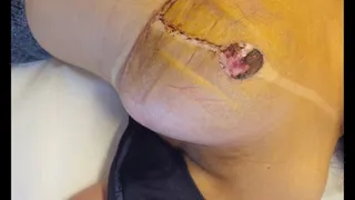 Post surgery 3 weeks - scars and nipple healing