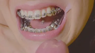 EPIC Braces HERBST and expander handjob