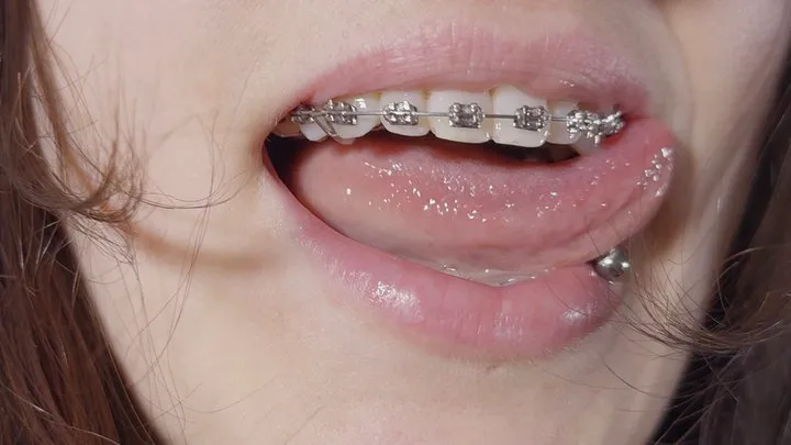 braces close-up and rubber-bands ASMR