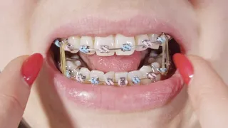 braces close-up and rubber bands ASMR