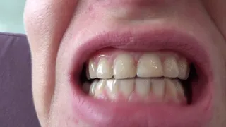 Sticky faces on my teeth