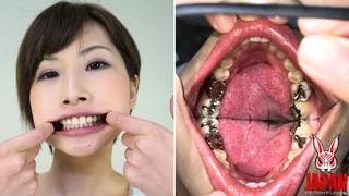 Teeth Inspection Chronicles: a full crown and inlays Yua Hidaka's Enigmatic Oral Realm