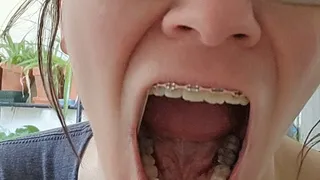 Braces and Spitting