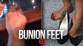 Fetish206 - Foot Fantasies, Bunion Feet 6