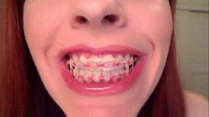 My Braces up close