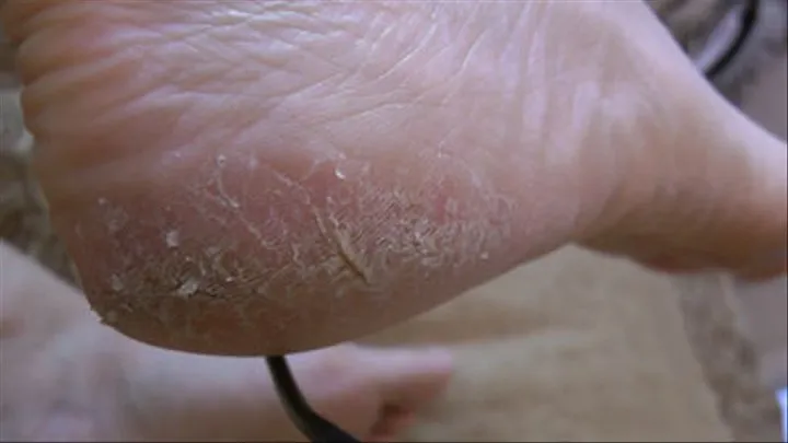 Dry Scaly Heel & Big Toe POV Full Screen