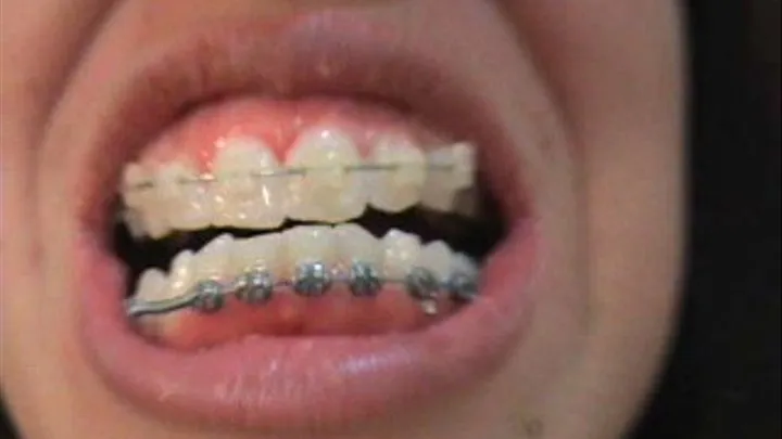 Brushing my braces and Teeth! - Low speed