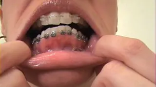 Braces Blowjob Instruction - Low speed