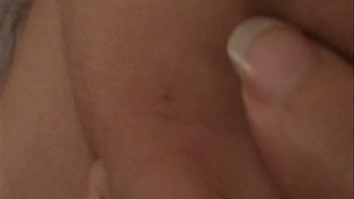 Popping and Squeezing Small Whiteheads and Examining Face and Pores--9 14--MVI 6206