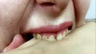 Bad Teeth