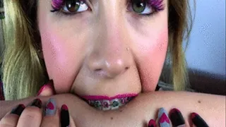 Marlena - Colorful Braces Bite