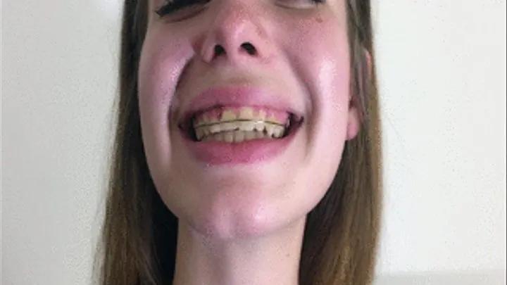 Klaras Braces For First Time