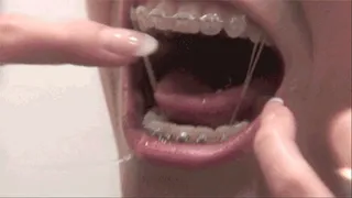 Teeth Brushing with Braces (QuickTime)