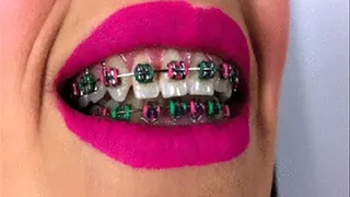 2 Clips - Colorful Braces Of Marlena - Mix