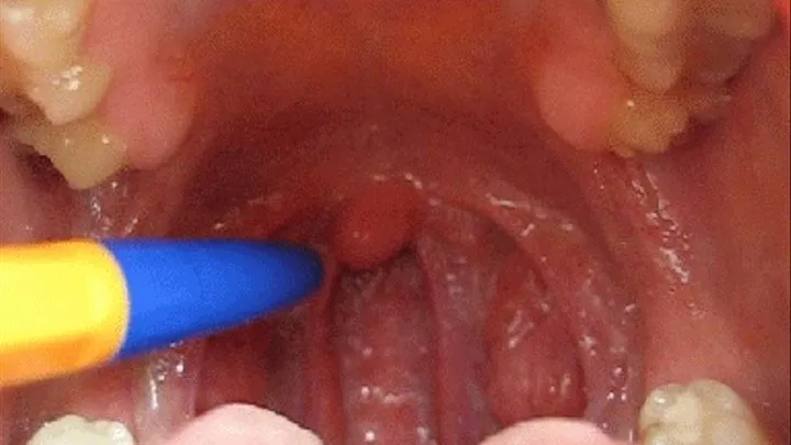 MY UVULA CLOSE UP (B)